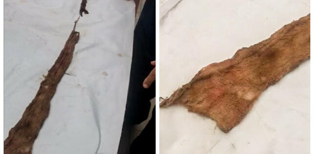 Şirvan sakininin qarnında 8 ay əvvəl əməliyyat zamanı unudulan tampon aşkar edilib - FOTO - VİDEO