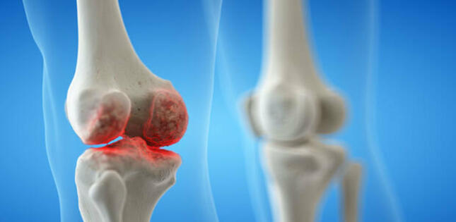 Diz-oynaq ağrılarında nəyə diqqət etməliyik? - VİDEO
